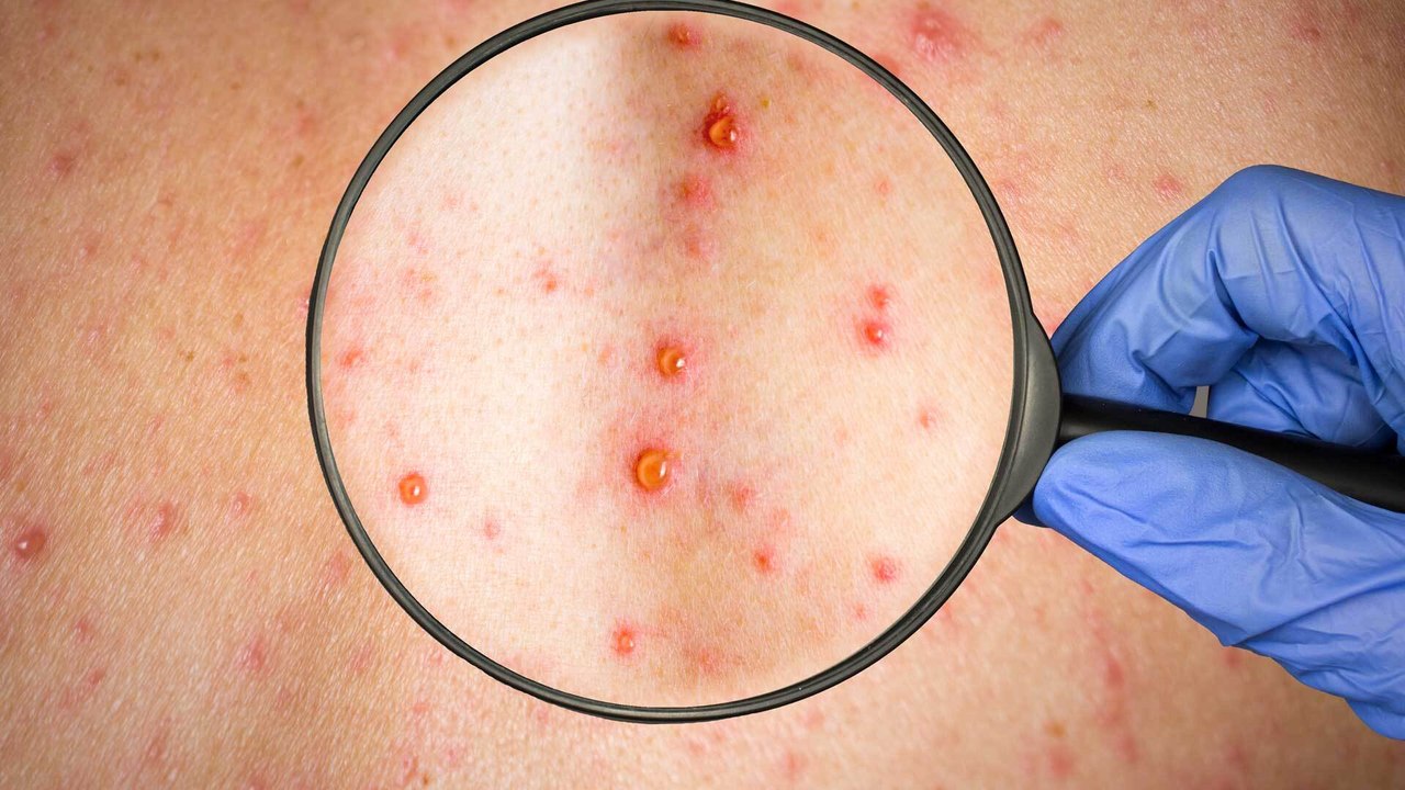 Affenpocken in der EU: Wie gefährlich sind sie wirklich?