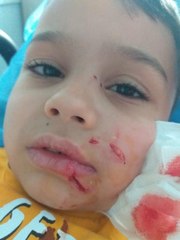 Niğde'de başıboş köpeğin saldırdığı Yiğit'e 11 dikiş atıldı