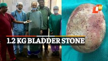 Bladder Stone Weighing 1.2kg Removed By Doctors