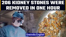 206 kidney stones removed from 56-year-old man in Hyderabad | Oneindia News
