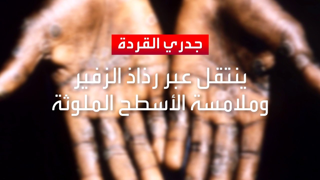 الصحة العالمية: الأسوأ فيما يتعلق بمرض جدري القردة لم يأت بعد