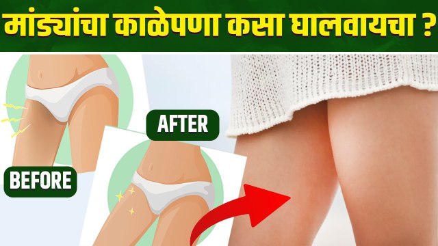 तुमच्या पण मांड्या काळे झाले आहेत का |How To Get Rid Of Dark Inner Thighs | Dark Inner Thighs Remedy