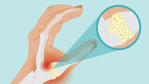 अंगूठे में दर्द और सूजन Artheritis Symptom, अंगूठे में दर्द का इलाज कैसे करें | Boldsky