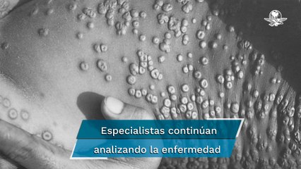 Viruela del mono: ¿es una enfermedad de transmisión sexual?