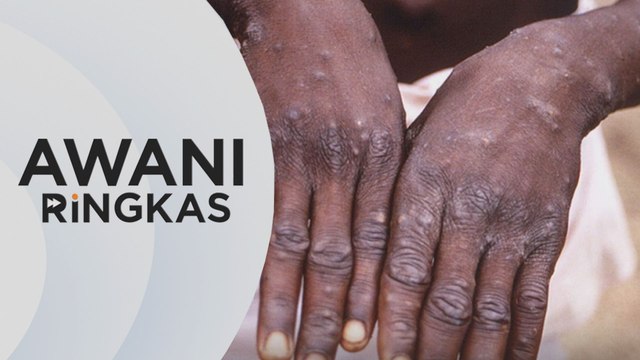 AWANI Ringkas: Ancaman virus cacar monyet di Malaysia