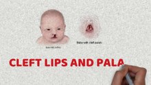 Cleft lip and cleft palate  (Facial and Oral Malformations)