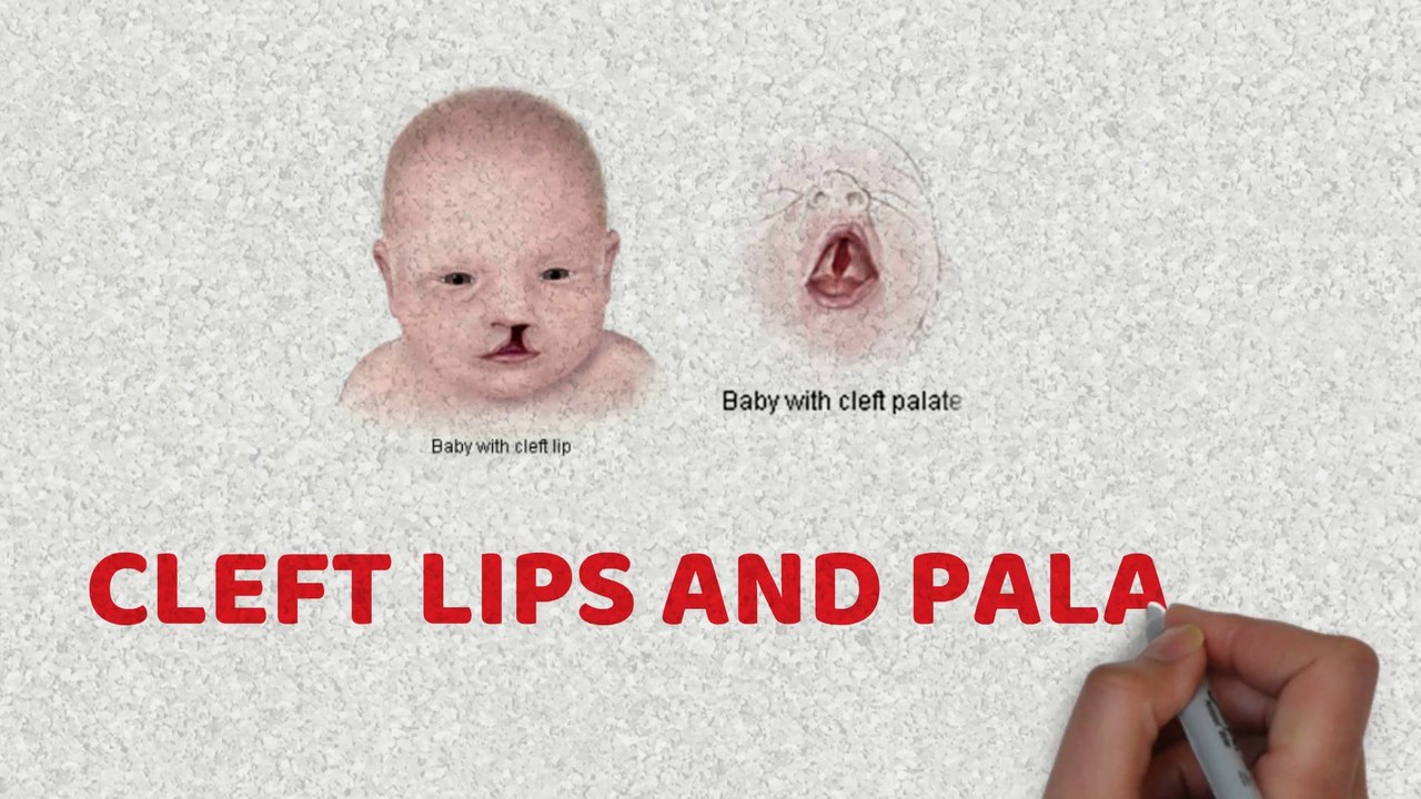 Cleft lip and cleft palate  (Facial and Oral Malformations)