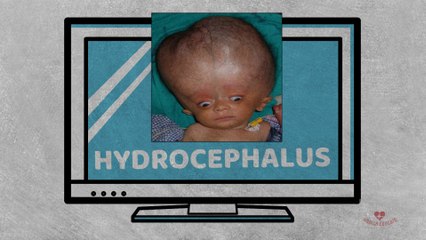 Hydrocephalus (Fluid in your Brain)