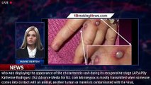 Monkeypox symptoms: The 7 early signs to look for - 1breakingnews.com