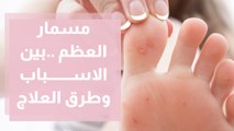 مسمار العظم .. أسبابه وطرق علاجه