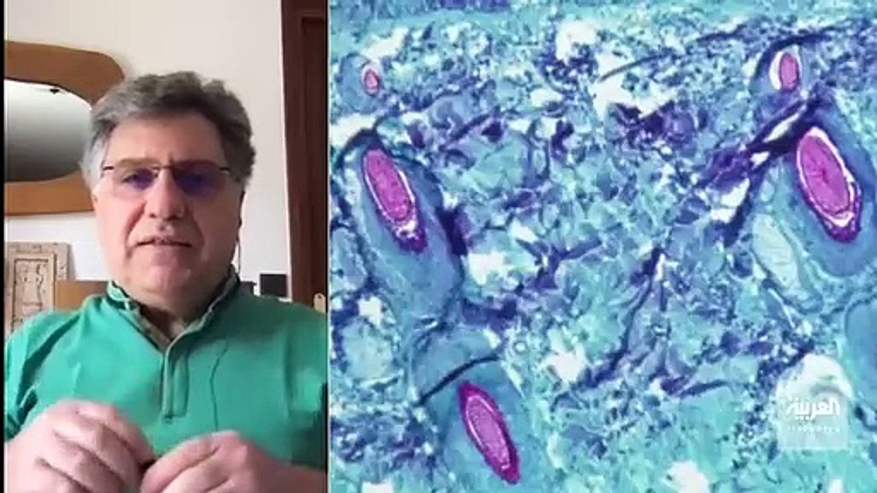 استشاري: ‎جدري القرود شديد العدوى ويستوجب عزل المريض 3 أسابيع