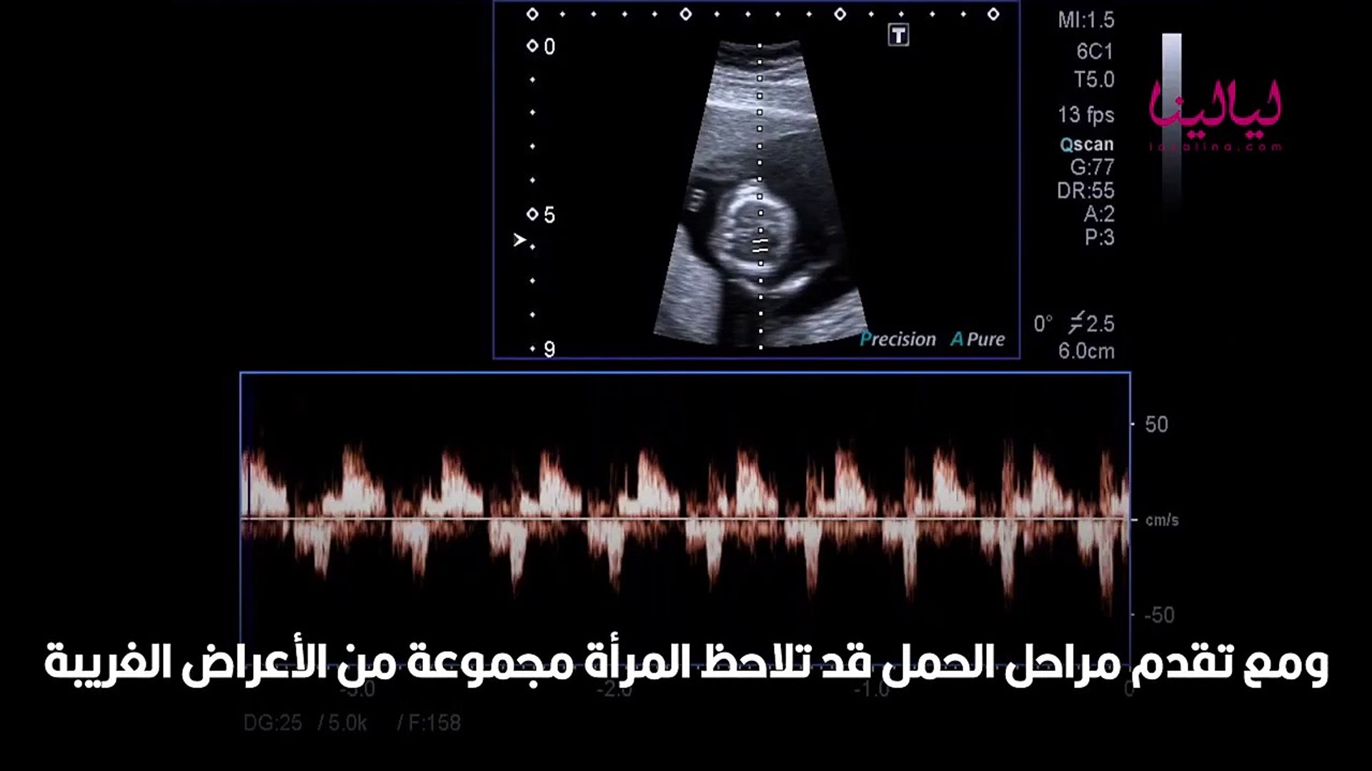 هل الحمل خارج الرحم يظهر في التحليل المنزلي - فيديو Dailymotion
