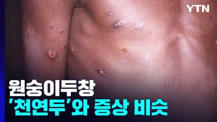 원숭이두창, 코로나보다 전파력 낮고 치명률 높아..."유입 대비" / YTN