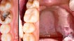 दांतों में दिखने वाले ये 4 संकेत गंभीर बीमारी के लक्षण । Boldsky