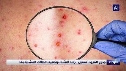 البلبيسي: "وباء" جدري القرود مستبعد.. و95 % يشفون تلقائيا