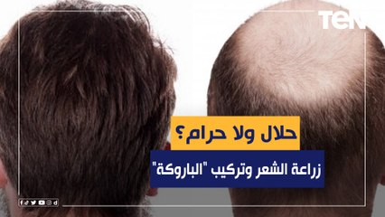 زراعة الشعر وتركيب "الباروكة" حلال ولا حرام؟.. شوف الناس زمان كانوا بيقولوا عليها إيه!