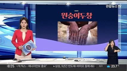 [그래픽뉴스] 원숭이두창