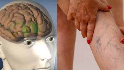 नसों की उभार शरीर के इन हिस्सों में खतरनाक, जानें लक्षण कारण । Boldsky