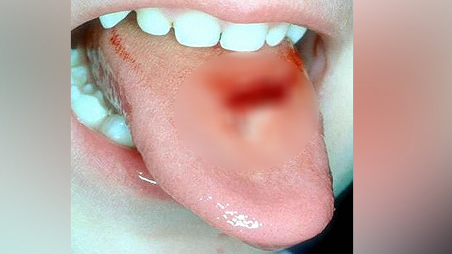 जीभ से खून आना है खतरनाक,जानिए कारण और उपाय । Boldsky - video Dailymotion