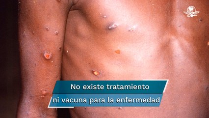 Autoridades sanitarias emiten alerta para detectar casos de viruela del mono en México