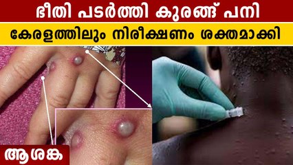 കോവിഡിന് പിന്നാലെ ഭീതി പടർത്തി കുരങ്ങ് പനി,