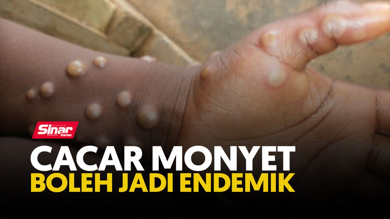 Cacar monyet boleh jadi endemik