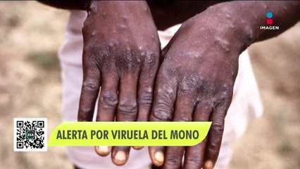OMS emite alerta por casos de viruela del mono