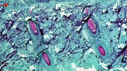 Smallpox Antiviral Drug May Be Mitigator for Monkeypox