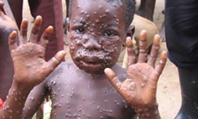 بلجيكا تفرض حجرًا صحيًا على المصابين بجدري القرود