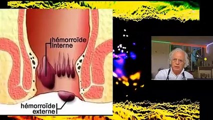452 HEMORROIDES CE QU'ON VOUS DIT JAMAIS DEMANGEAISON ANUS CONSTIPATION COLOPATHIE BIEN-ETRE SANTE