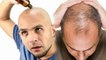 बालों में रोज तेल लगाने से गंजापन दूर होता है ? । Expert Advice । Boldsky