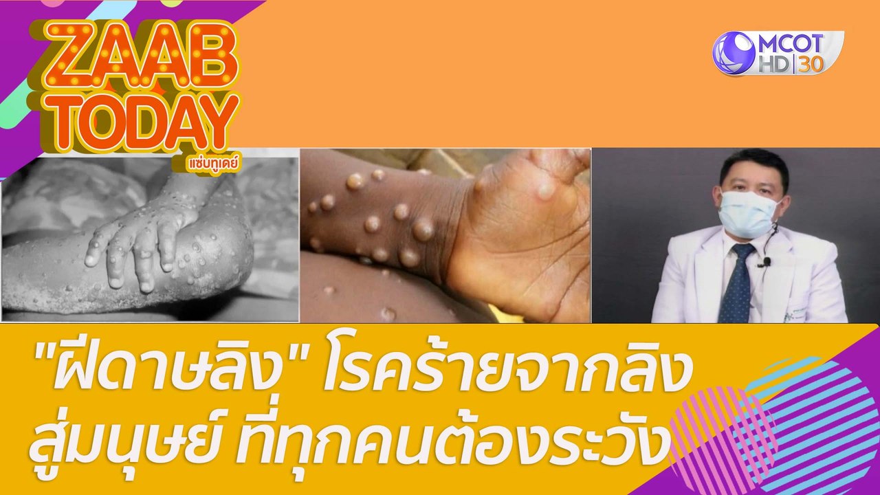"ฝีดาษลิง" โรคร้ายจากลิงสู่มนุษย์ ที่ทุกคนต้องระวัง : แซ่บทูเดย์ (26 พ.ค. 65) OnAir