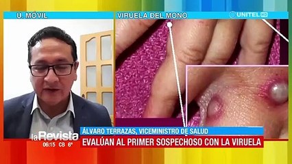 Sospechoso de viruela del mono: se prevé que en una semana se tengan los resultados