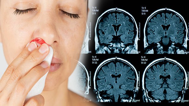 गर्मी में नाक से खून आने का क्या कारण है | गर्मी में नाक से खून आना | Boldsky