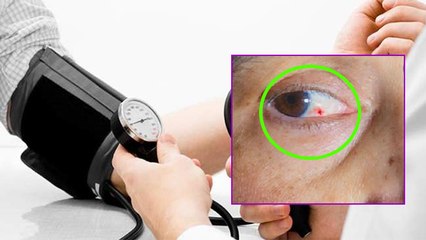 High BP से Eyes Damage, Blood Spot से लेकर Optic Neuritis का खतरा | Boldsky