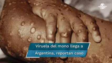 Argentina reporta el primer caso de viruela del mono en América Latina