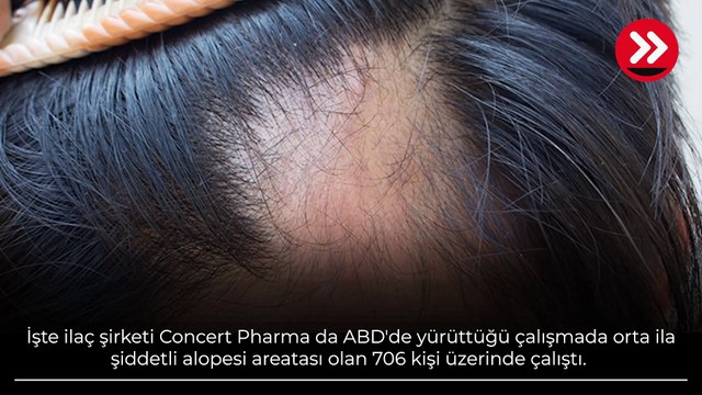 6 ay sonra yeniden saçları çıktı! 'Bu ilaç umut olabilir'