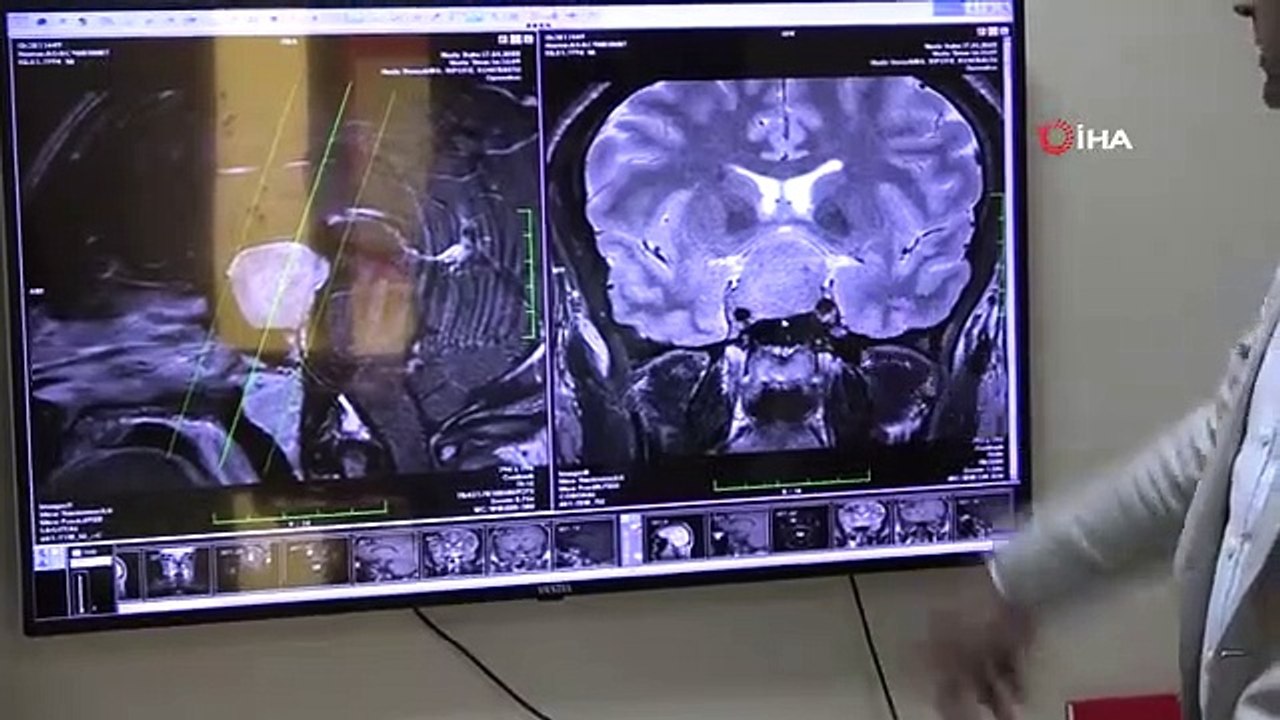 Baş ağrısı beyin hastalıklarının habercisi