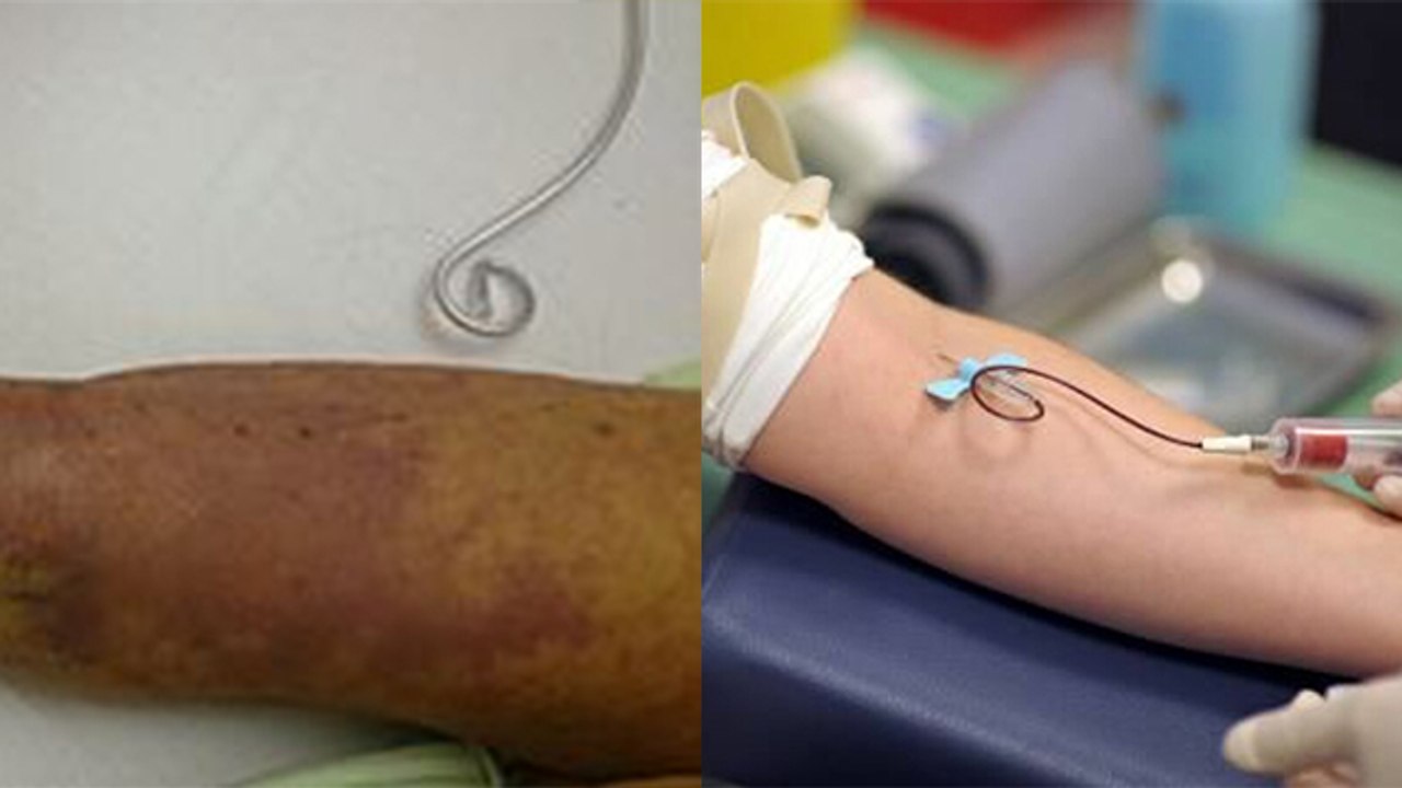 खून को जहर बनाती है ये गंभीर बीमारी, ये है लक्षण और बचाव के तरीके | Boldsky #Health
