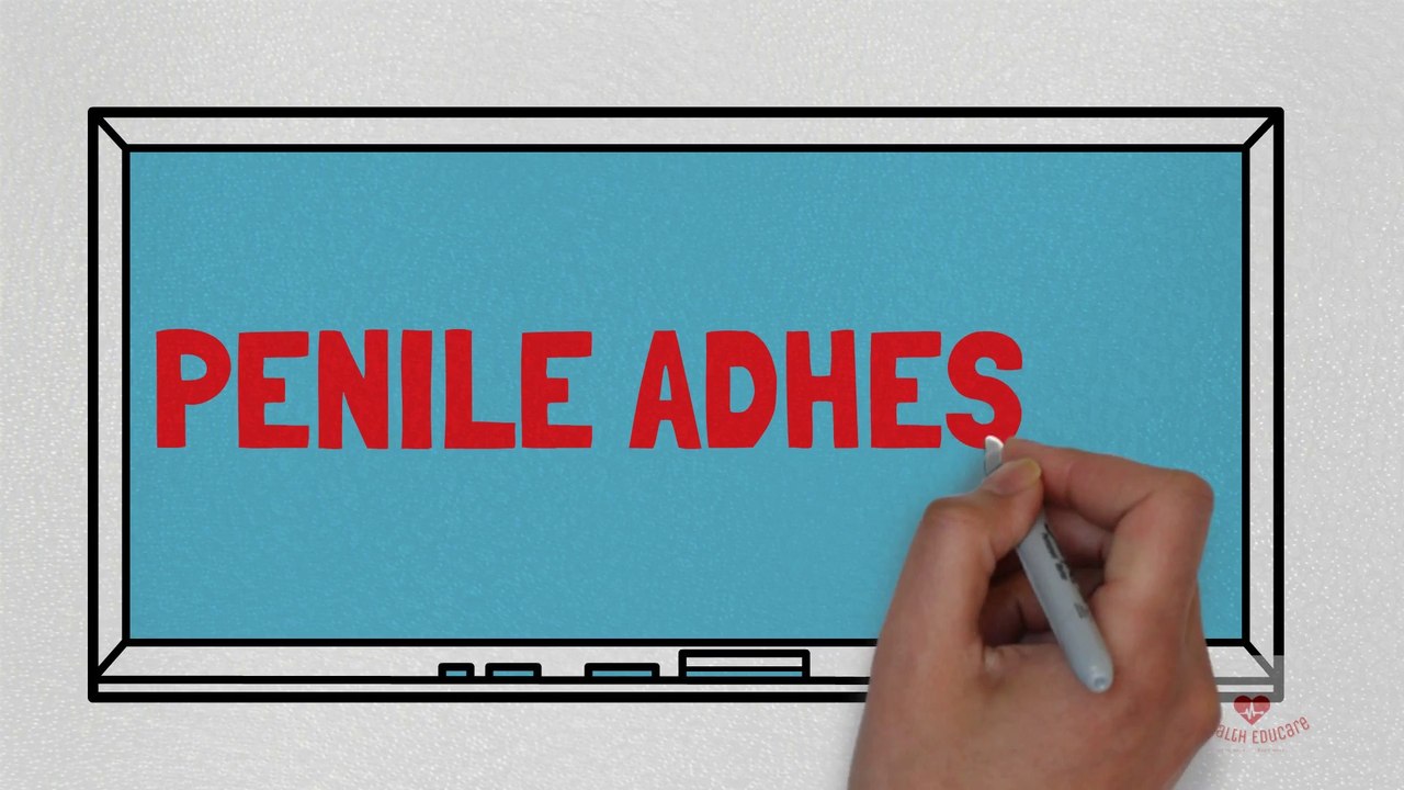 Penile Adhesion - Foreskin attached to the head of the glan - video ...