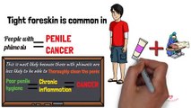 Can Phimosis (Tight foreskin) cause Penile cancer