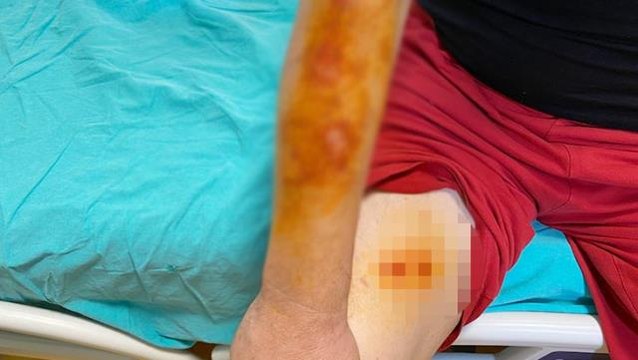 Lavabo açıcı bomba gibi patladı! Canı yanan adam soluğu hastanede aldı