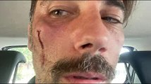 Vittorio Brumotti San Severo, aggressione per l'inviato di Striscia la notizia: prognosi di un mese