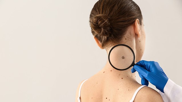 bd-cancer-de-piel-o-lunar-300522