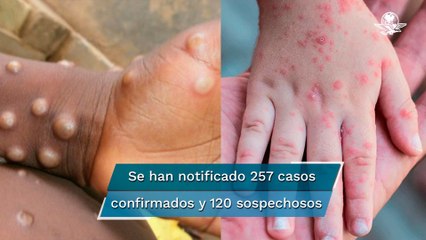 OMS afirma que es "poco probable" que la viruela del mono se convierta en pandemia