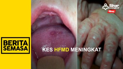 Kes HFMD meningkat 27 kali ganda