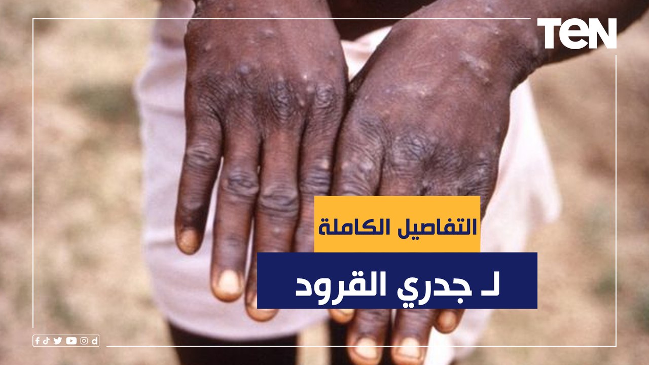 جدري القرود .. كل ما تريد معرفته عن الفيروس