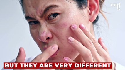 How to tell the difference between pimple and genital herpes