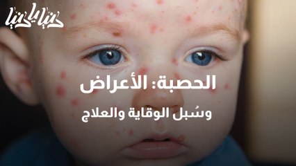 بعد رصد حالات حصبة في الأردن .. هذه الأعراض وسُبل الوقاية