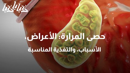 حصى المرارة الأعراض، الأسباب، والتغذية المناسبة